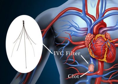 IVC Filters