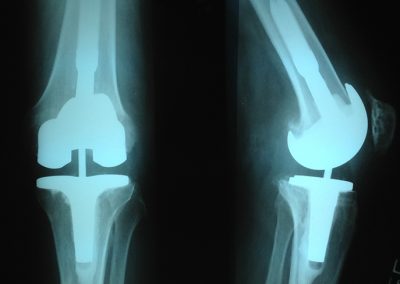 Knee Implants